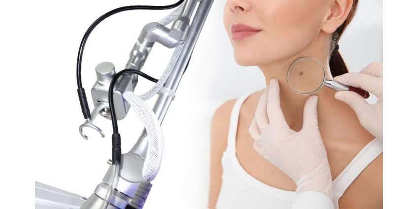 Як позбутися папілом?