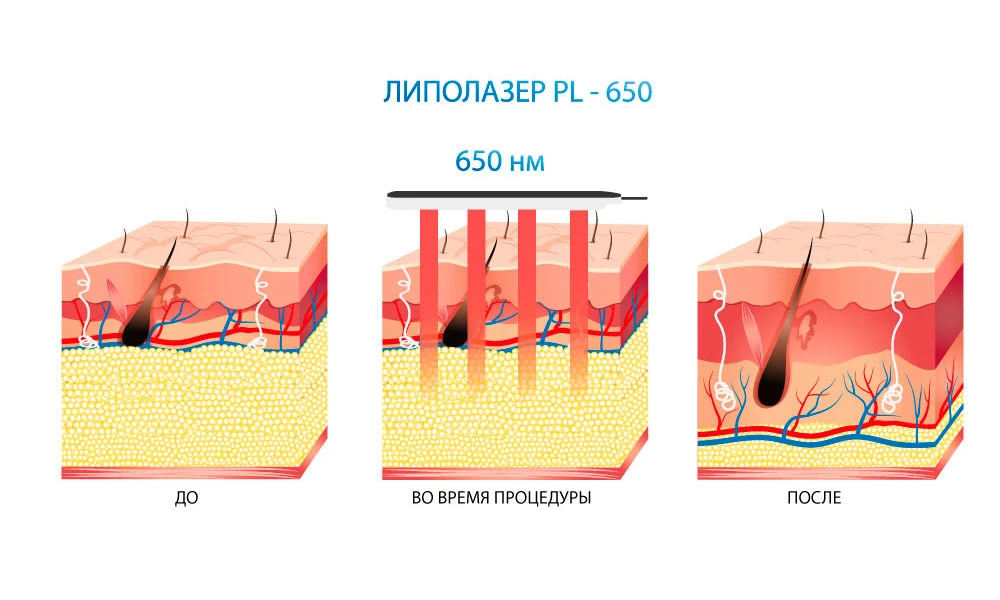 специфіка ліполазерів
