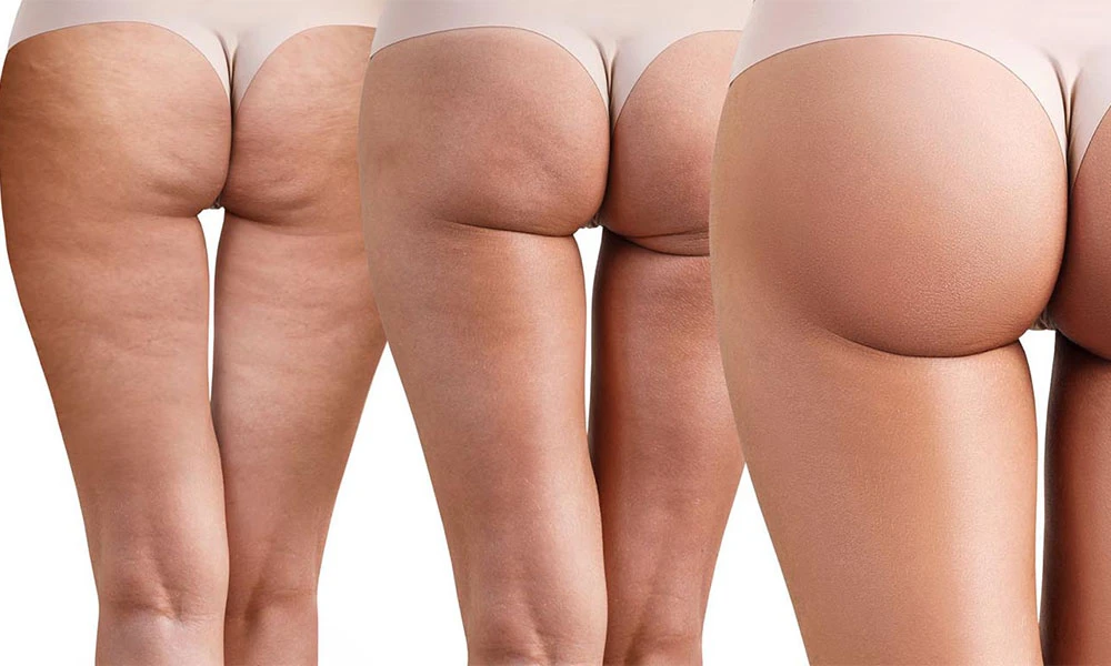 показання до лазерного ліполізу