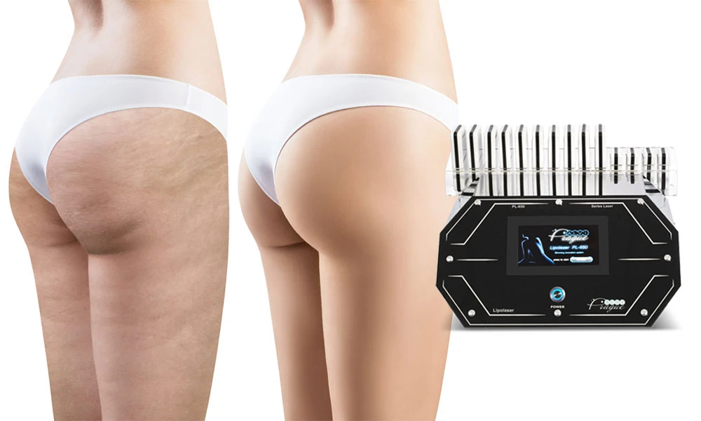 переваги лазерного ліполізу