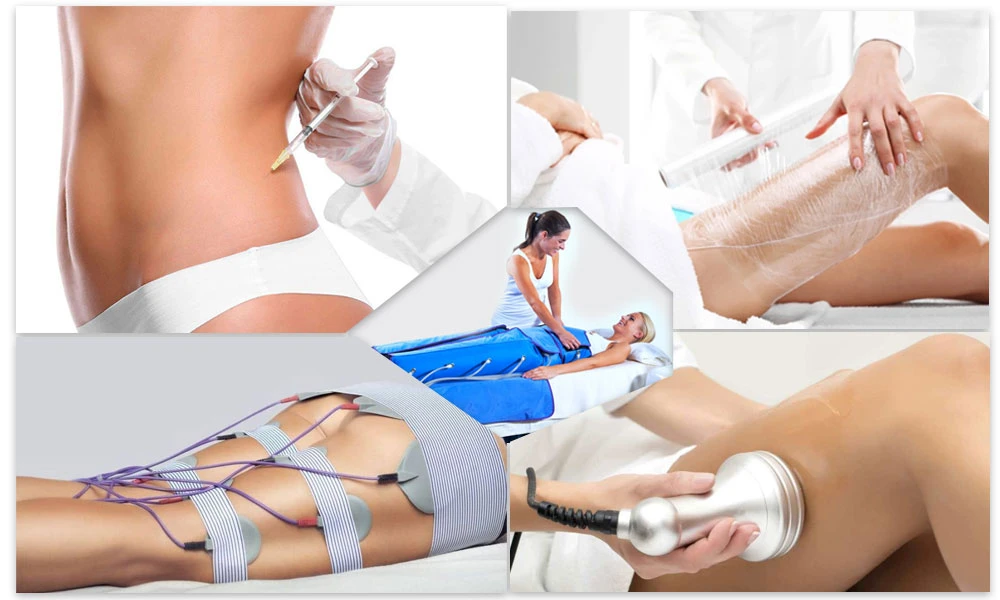 лазерний ліполіз