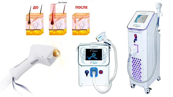 апарати для лазерної епіляції купити Київ