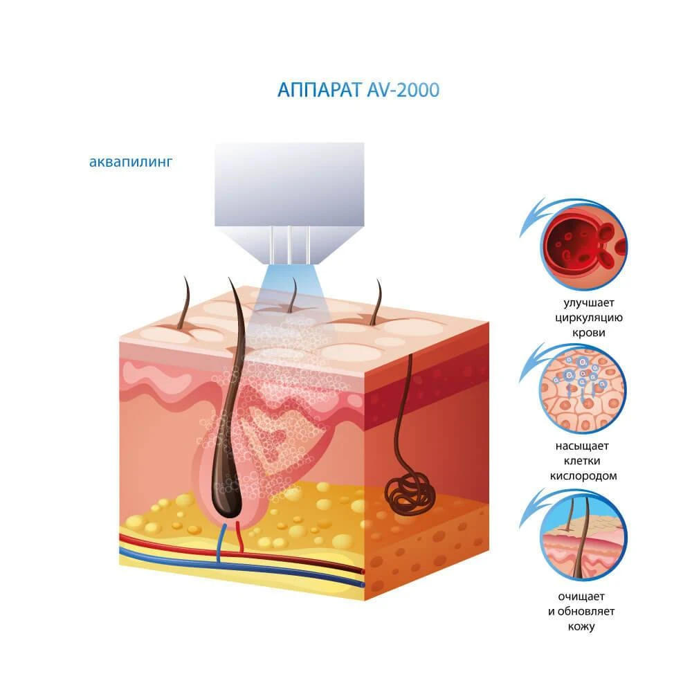 аппарат газожидкостного пилинга AV-2000 цена украина