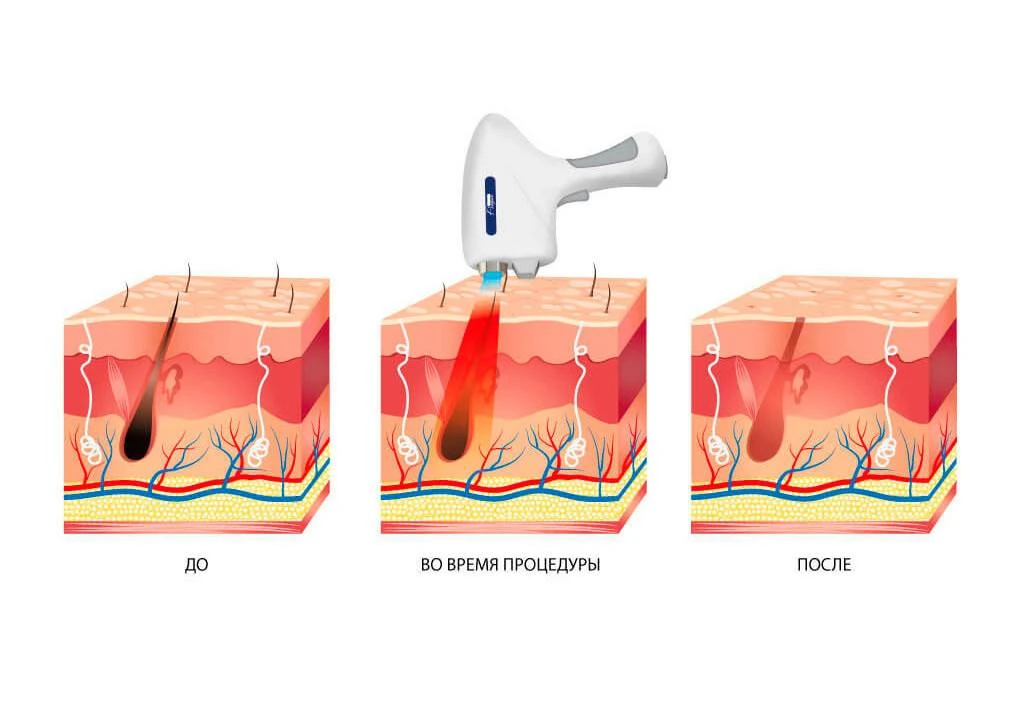 діодний лазер DL-6000 OptiPulse Pro купити