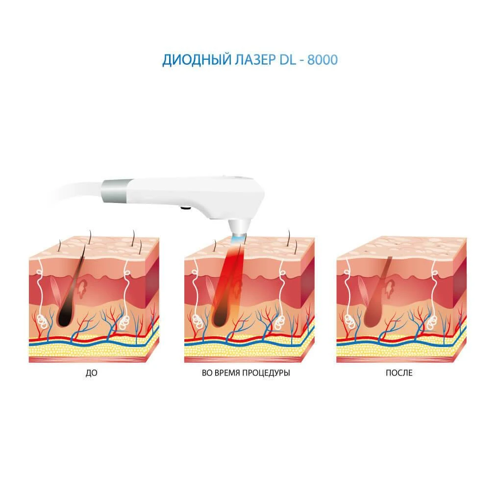 диодный лазер принцип работы украине