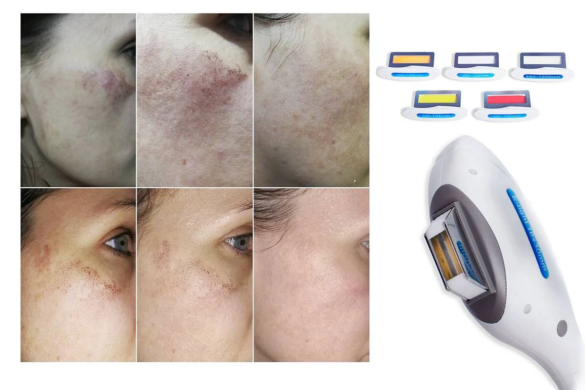 професійний фотоепілятор IP-200 + купити київ