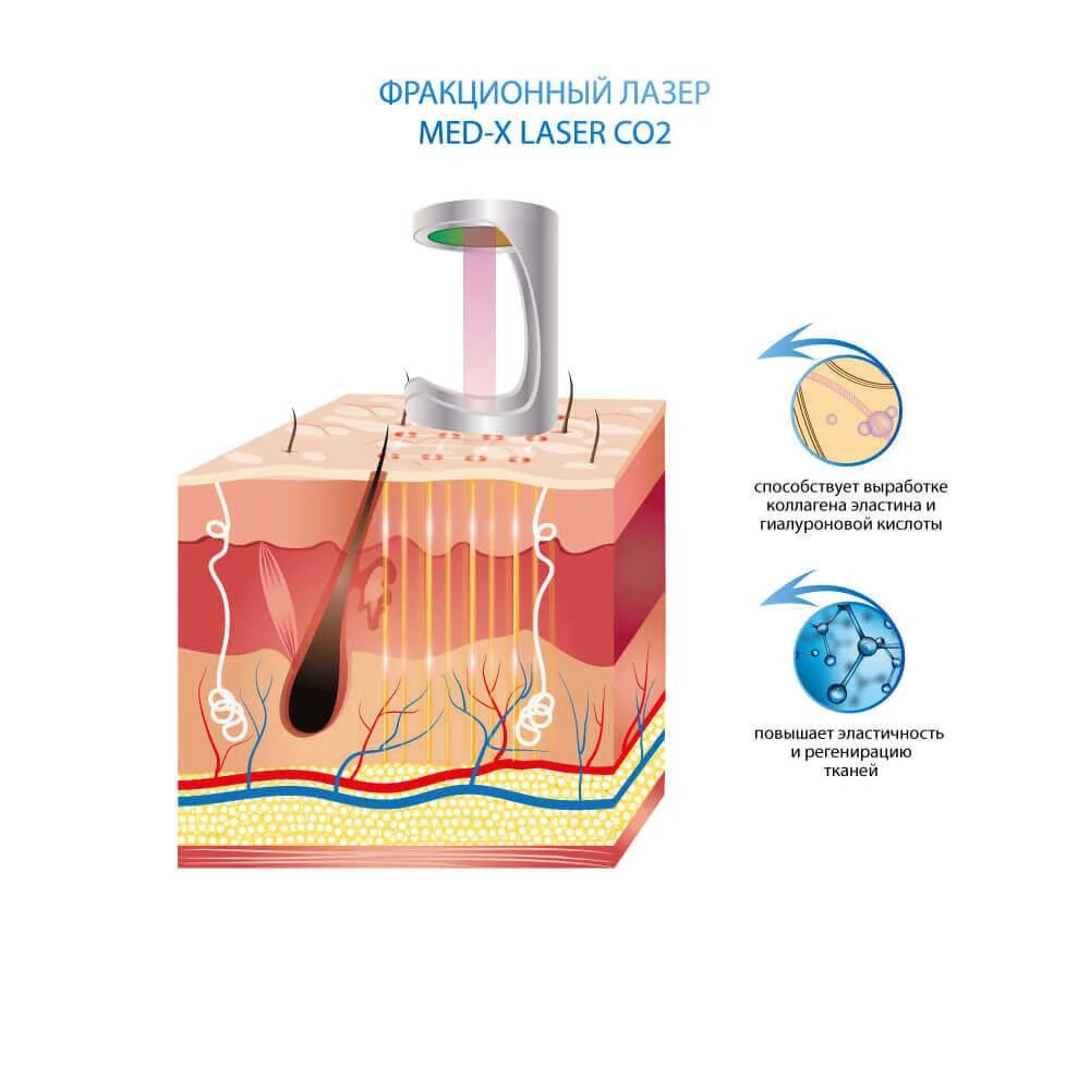 ефекти застосування лазера фракційного косметології