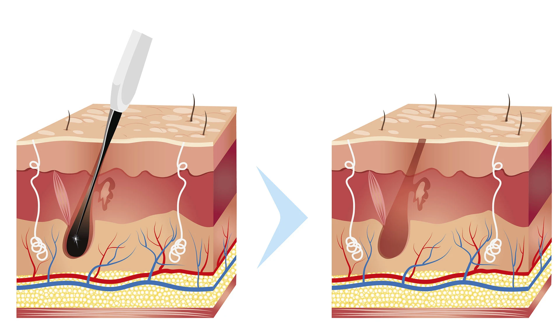 купить аппарат для электроэпиляции Epil Ultimate N-01