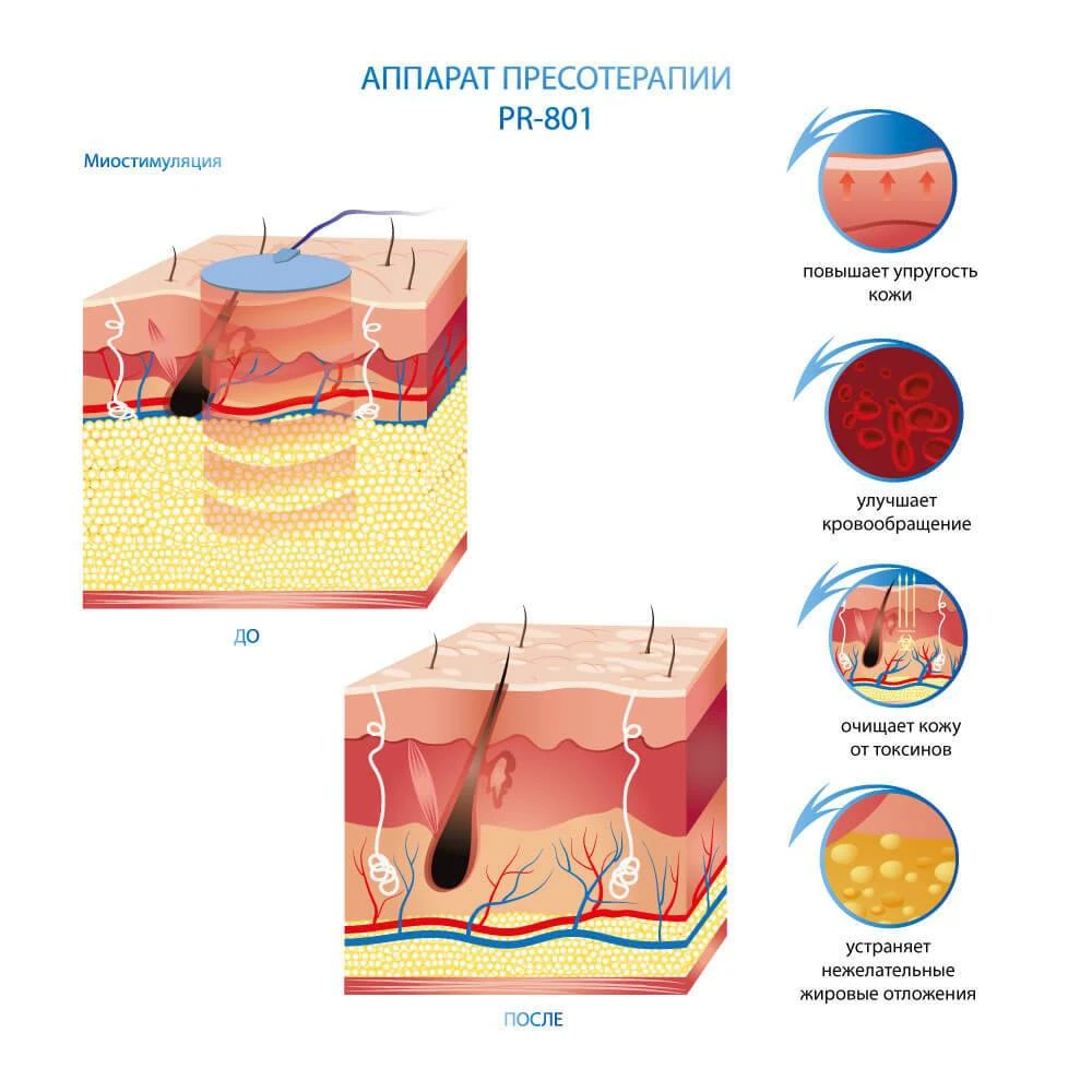 ефект апарату пресотерапії України
