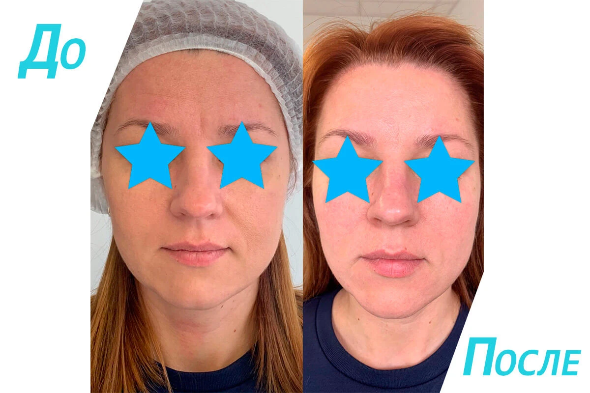 применение аппарата смас лифтинга