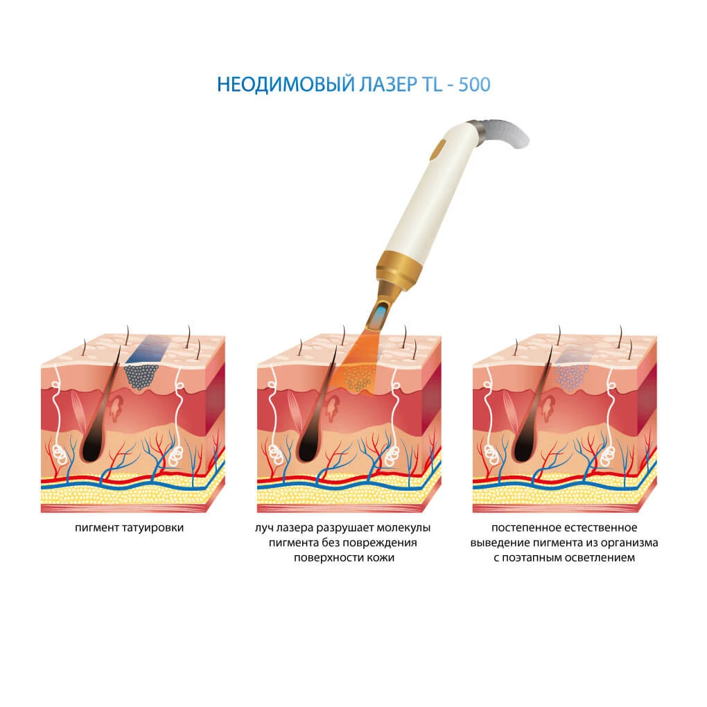 принцип роботи лазер для видалення тату Neo-Light TL-500