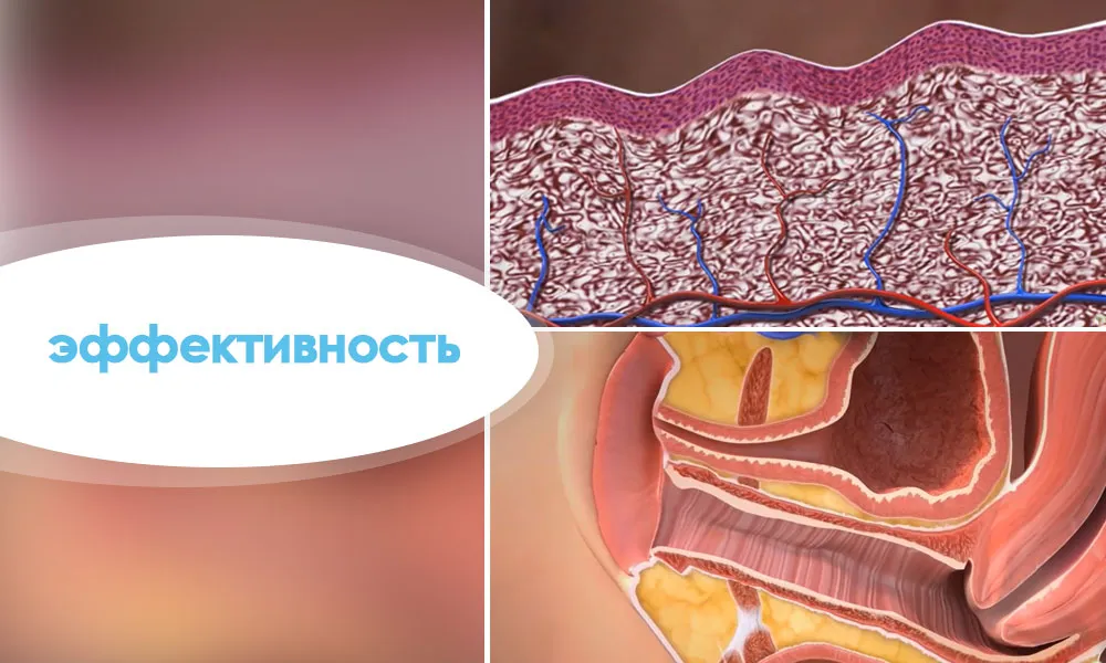 ефективність лікування вульвовагінальної атрофії СО2 лазером
