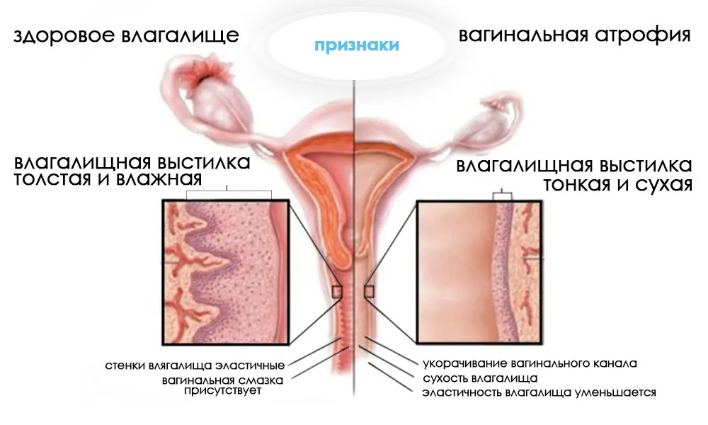 ознаки вульвовагінальної атрофії