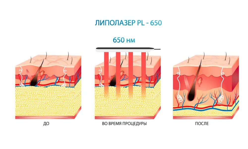 специфика липолазеров