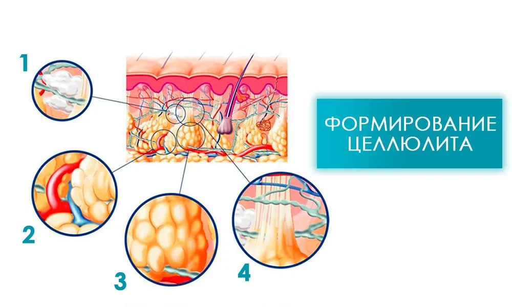 лазерний ліполіз у корекційних процедурах