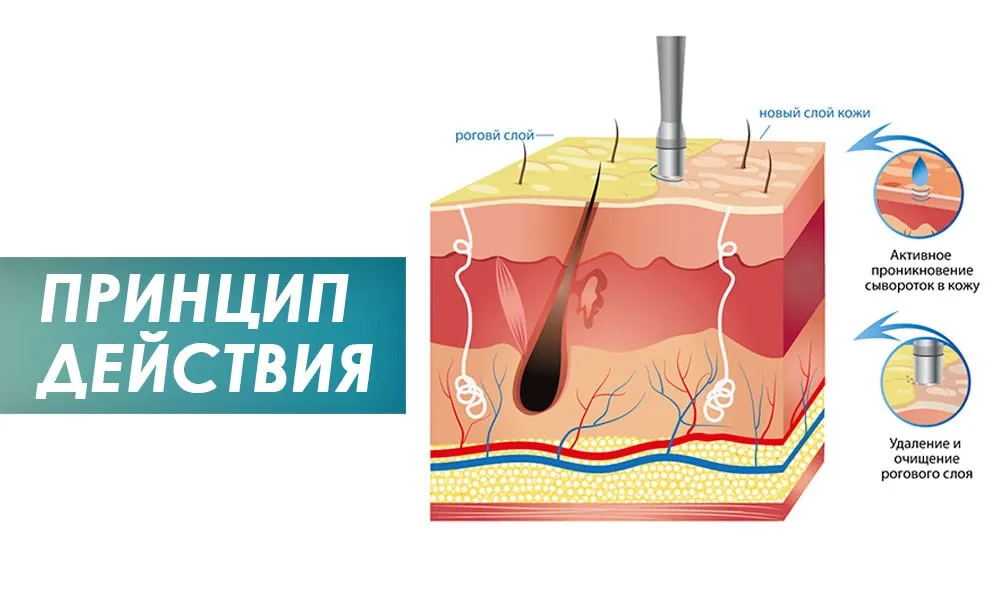 принцип дії алмазної мікродермабразії
