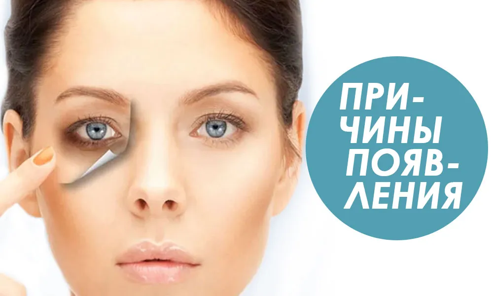 причины появления темных кругов под глазами
