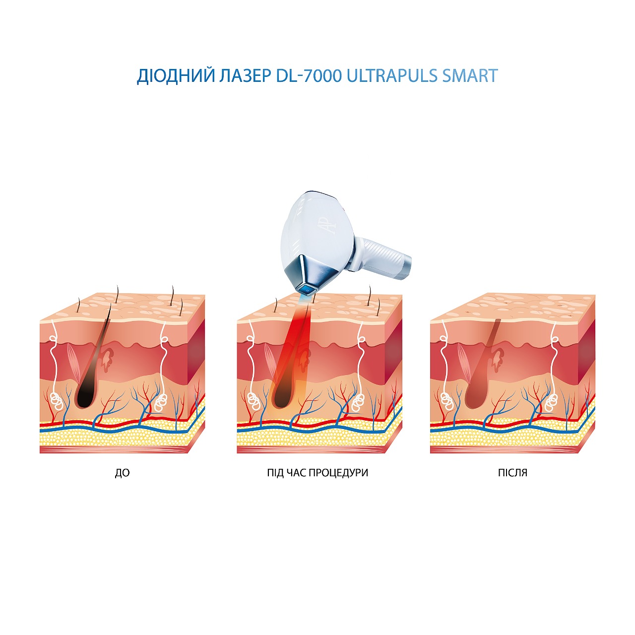  crm для діодного лазера DL-7000 UltraPuls Smart