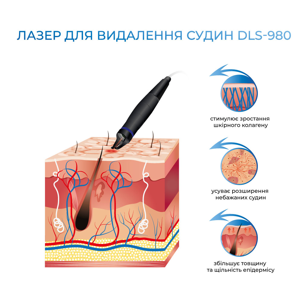 принцип лазера для видалення судин dls-980