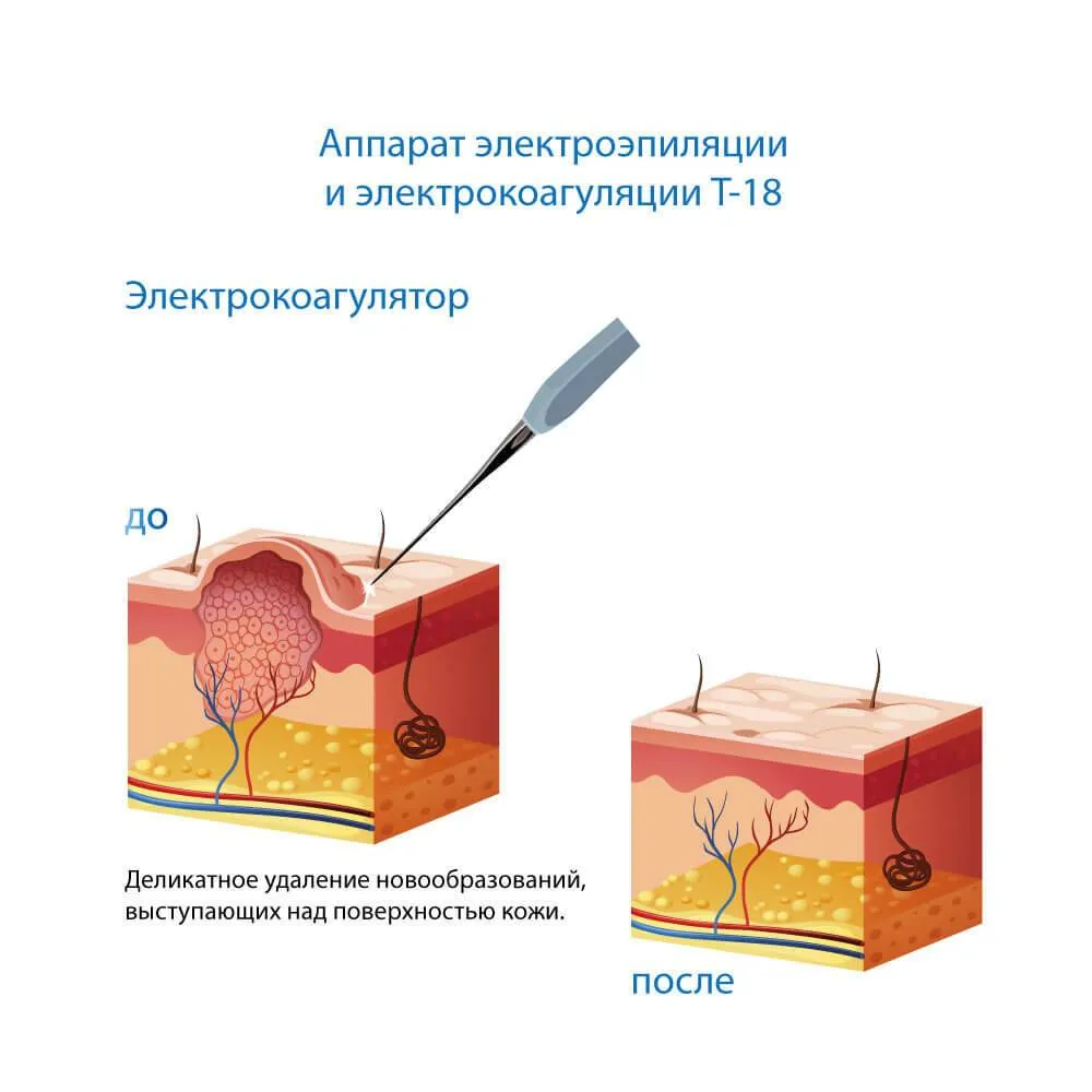 електрокоагуляція апаратом електроепіляції Т-18
